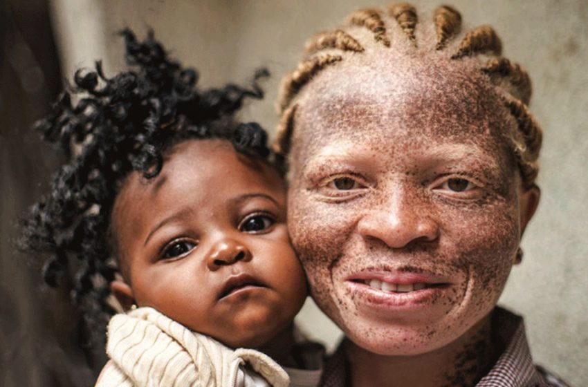  Some photos showing the difficult life of albinos