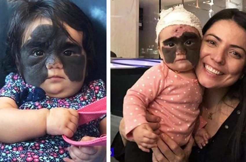  “There are no more spots”: the baby with the “mask” on her face was cured