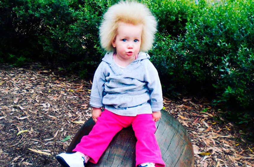  How the girl with the “uncombable hair” syndrome looks like now in her 12