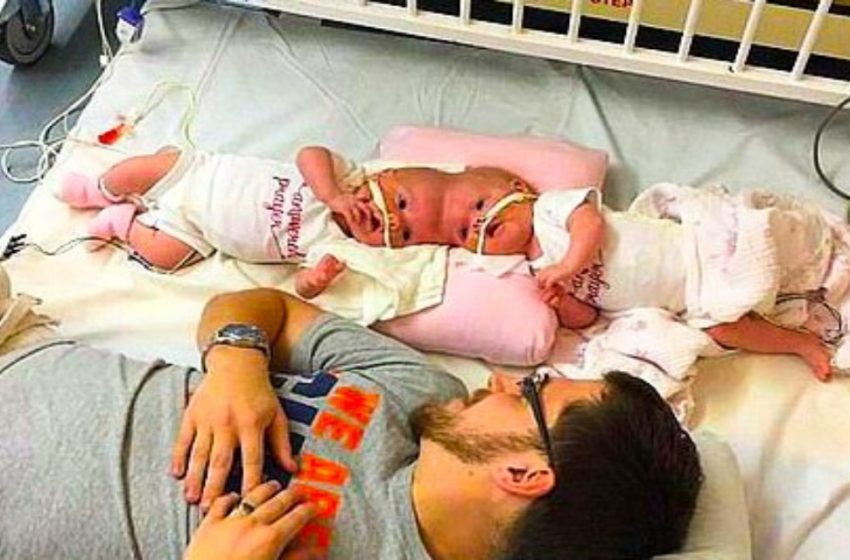  These Siamese twins are surely happy to be separated at their little age