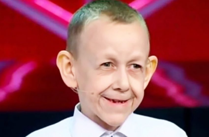  “Like the story of Benjamin Button”: What does the mother of 8-year-old boy with the face of an old man look like?