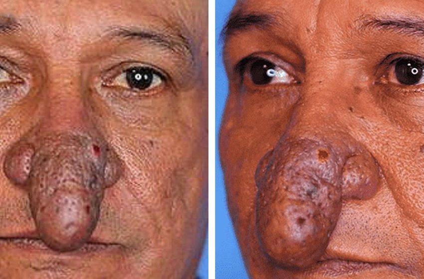  “I couldn’t eat because of my nose.” “Pinocchio” from the USA showed what he looked like after plastic surgery