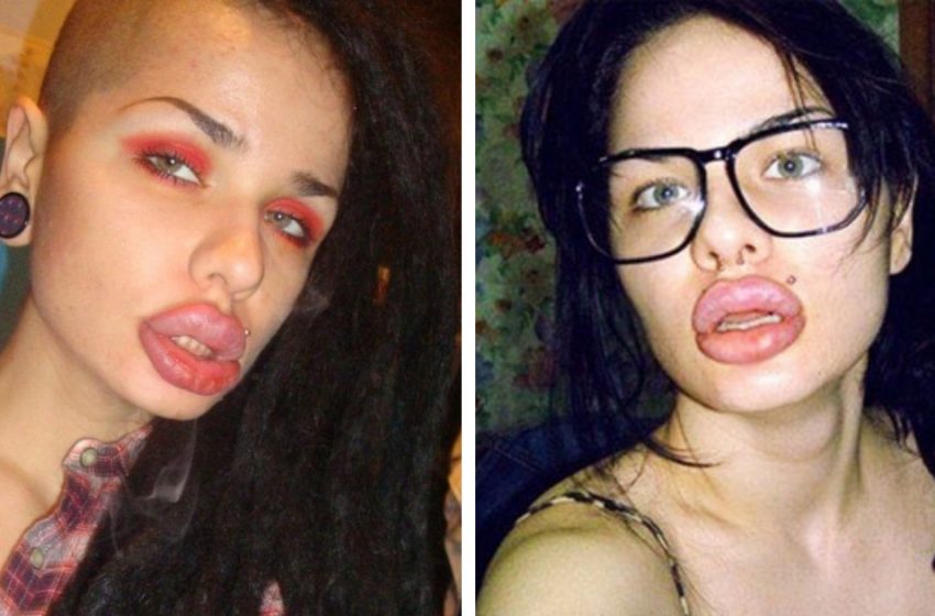  They went too much in the pursuit of beauty: Girls who spoiled themselves drastically by lip augmentation