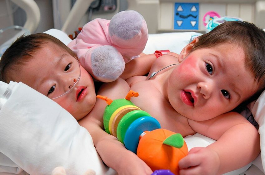  Siamese twins from Mexico: how Renata and Regina look almost 17 years after separation