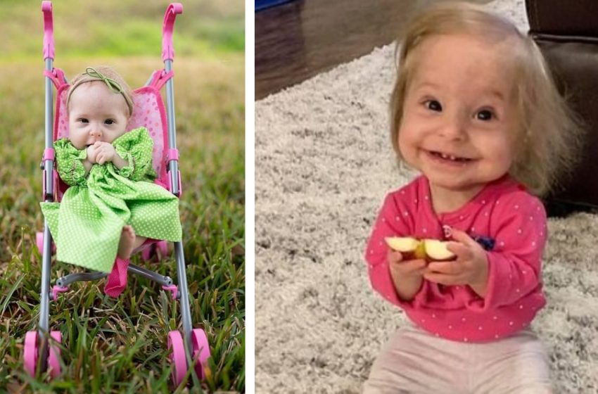  “Meet The Thumbelina Girl”: The Amazing Story Of a Special Baby Born With a Rare Condition!