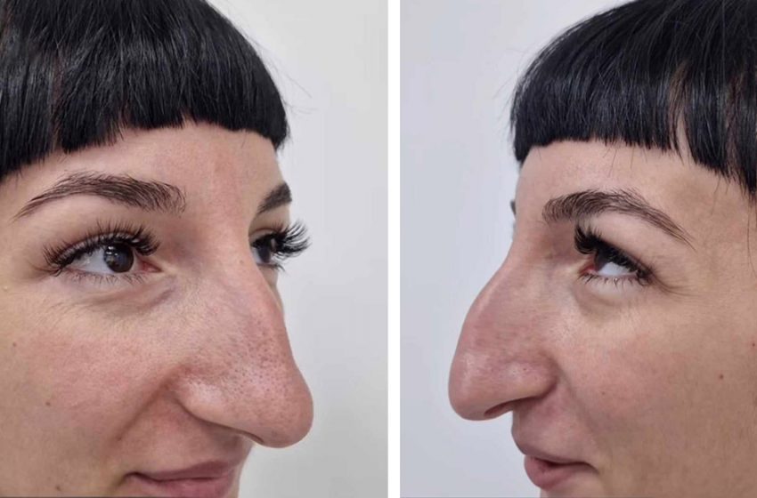  “A Surgeon Or A Wizard?”: A Girl With a Big Nose Has Transformed Beyond Recognition After Plastic!