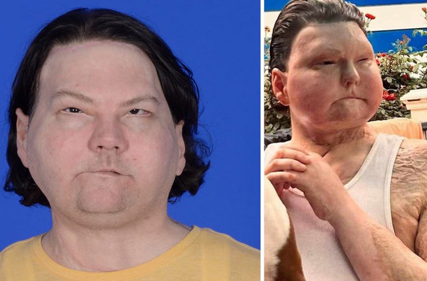  “Unbelievable Story!”: What Does The Girlfriend Of The Guy Who Underwent The World’s First Successful Face And Hand Transplant Look Like?