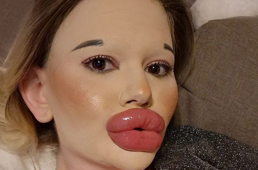  25-year-old Girl Has Had More Than 27 Procedures: Now She Has The Biggest Lips In The World!