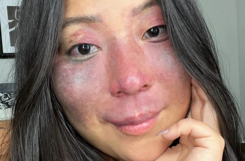  “Passers-by Always Look Askance At Her Because Of The Prominent Inborn Birthmark On Her Face”: The Girl Dared To Share Her Photos Without Makeup And Fillers!
