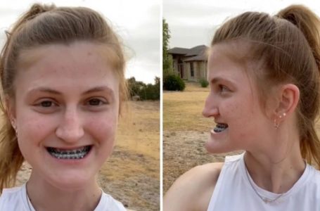 The Case When Plastic Surgery Was Super Necessary: The Girl With A Severely Protruding Lower Jaw Showed Herself After Her Double Jaw Surgery