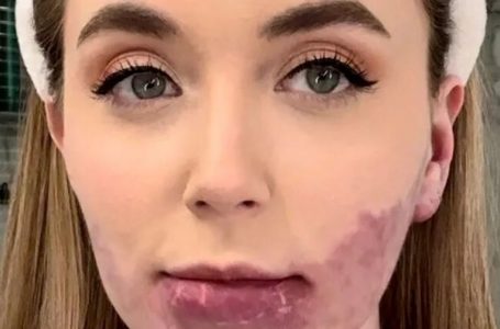 “She Had a Large Birthmark On Her Face”: What Does The Girl Look Like After 20 Facial Surgeries To Remove a Birthmark?