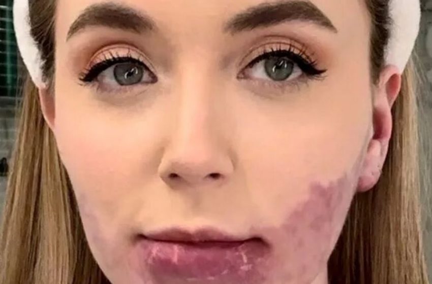  “She Had a Large Birthmark On Her Face”: What Does The Girl Look Like After 20 Facial Surgeries To Remove a Birthmark?