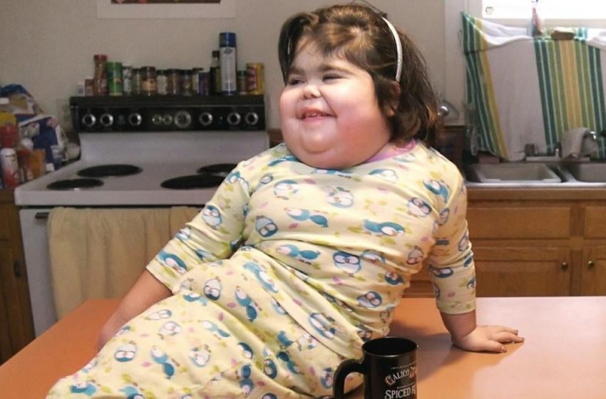  “I’m Just Like Everyone Else – a Human Being”: What Did The Girl Born With a Rare “Mermaid Syndrome” Look Like?