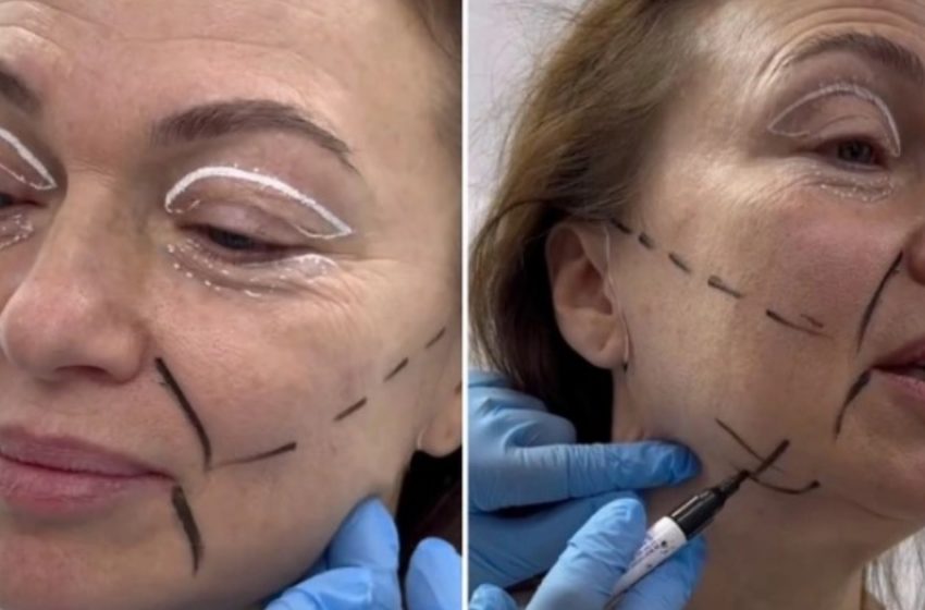  “A 58-Year-Old Woman Surprised Everyone With The Results Of Her Facelift Surgery: Shen Even Consider Updating Her Passport!