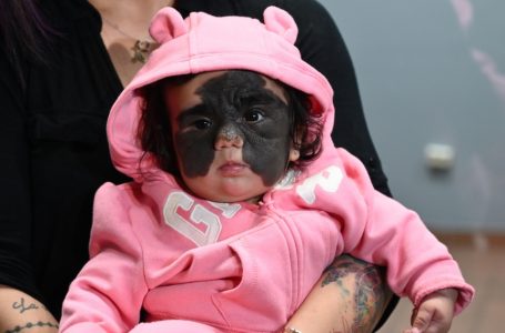 “There Will Be No Marks Left On Her Face”: What Does The Girl With The “Batman Mask” Look Like After The Surgery?