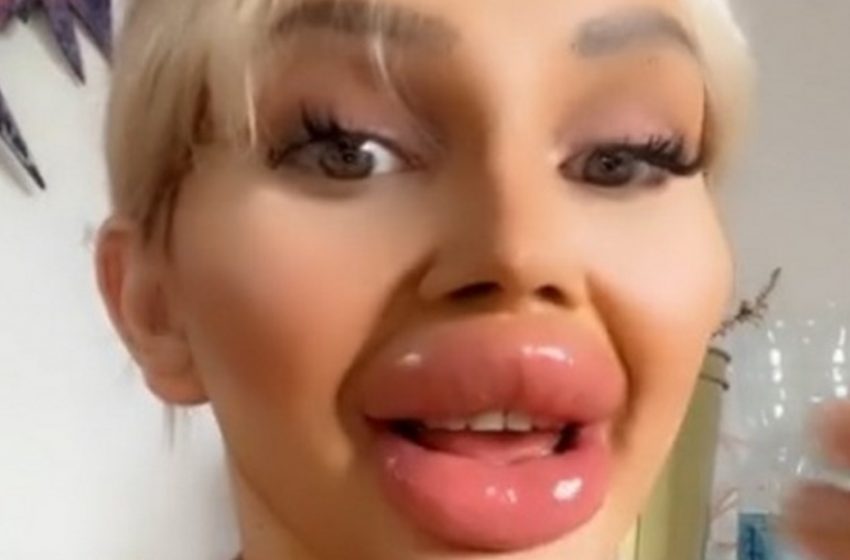  “Terrifying “beauty””: What Does The Girl With 1 Oz Of Filler In Her Lips Look Like?