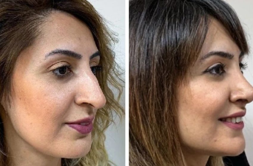  10 Women Who Proved That a Small Nose Change Can Make a Big Difference: Amazing Photos Before vs After!