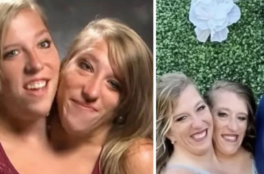  One Of These Conjoined Twins Got Married: And Everyone Is Asking The Same Questions!