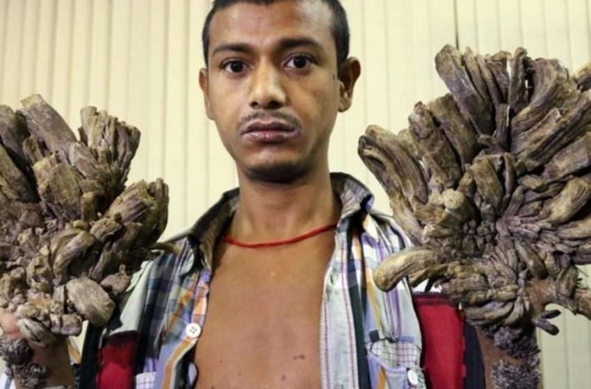  The Man Born With a Rare Condition Is Often Called “The Tree Man”: He Is Happy To Be Able To Hug His Daughter Again After Numerous Surgeries!