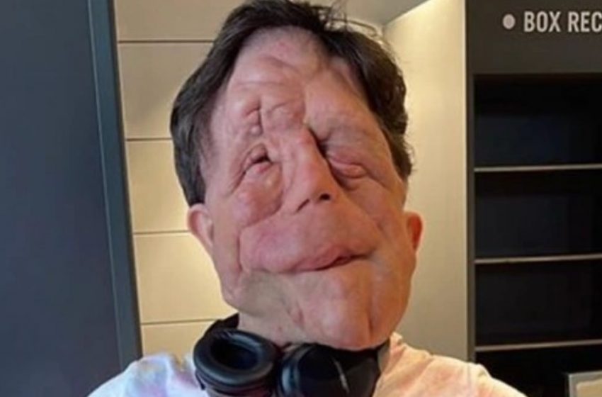  “Inspiring Story Of Adam Pearson”: How The Man With “Unique” Appearance Overcame His Condition And Became a Role Model!