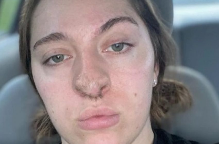  A Woman Who Was Attacked by a Dog, Now Has Hair Growing on Her Nose: Shocking Details And Photos On The Story!