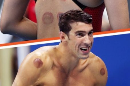 Wondering About the Circular Bruises on Olympic Athletes?: Here’s Why!