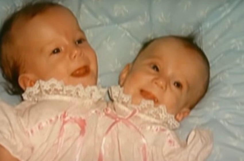  “Once They Paid Twice For College Now Share a Single Salary”: Pics Of The Conjoined Twins Now!