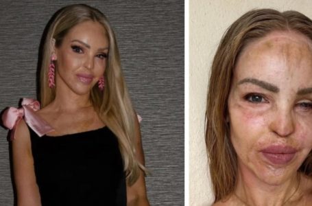 Katie Piper Shares Inspiring Update 16 Years After Surviving Acid Attack: Unexpected Details!