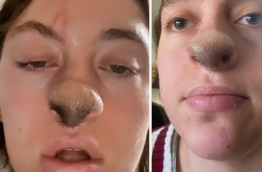  Dog Bite Leads To Hair Growing On Woman’s Nose: Photo Reveals Shocking Aftermath!