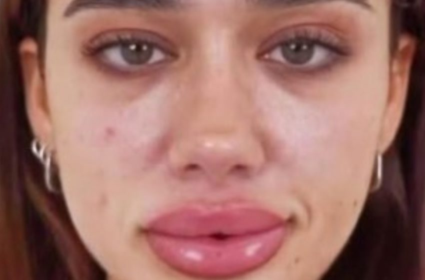  “From Bold to Elegant”: Woman’s Lip Reduction Surgery Transforms Her Look!