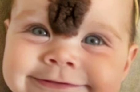 Parents Remove Baby’s Rare Birthmark to Shield Her from Cruelty!: See What She Looks Like Today!