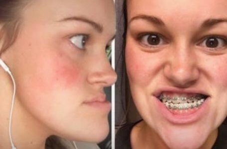 Woman Who ‘Hated Looking in the Mirror’ After Double Jaw Surgery Reveals Her New Look!: What Does She Look Like Now?