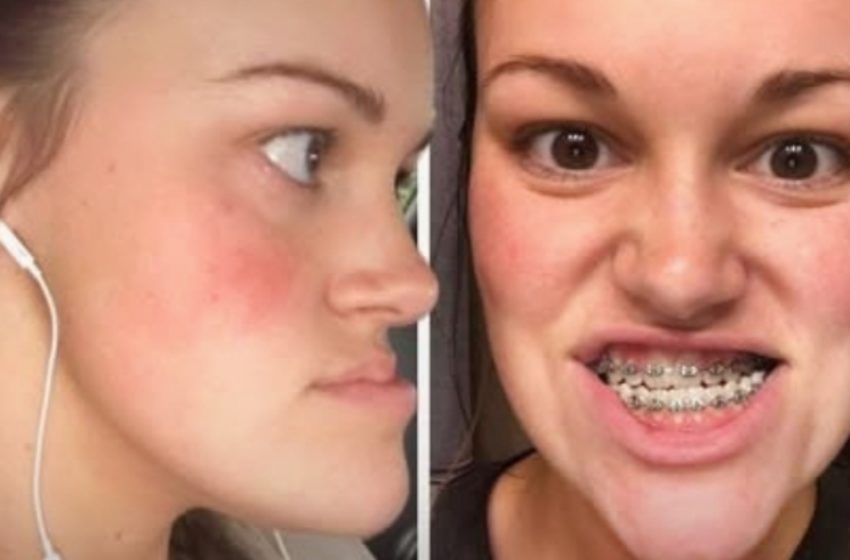 Woman Who ‘Hated Looking in the Mirror’ After Double Jaw Surgery Reveals Her New Look!: What Does She Look Like Now?