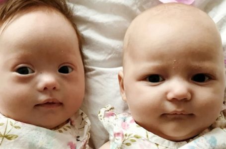 Twins with 1-in-a-Million Odds: One Has Down Syndrome, the Other Does Not!