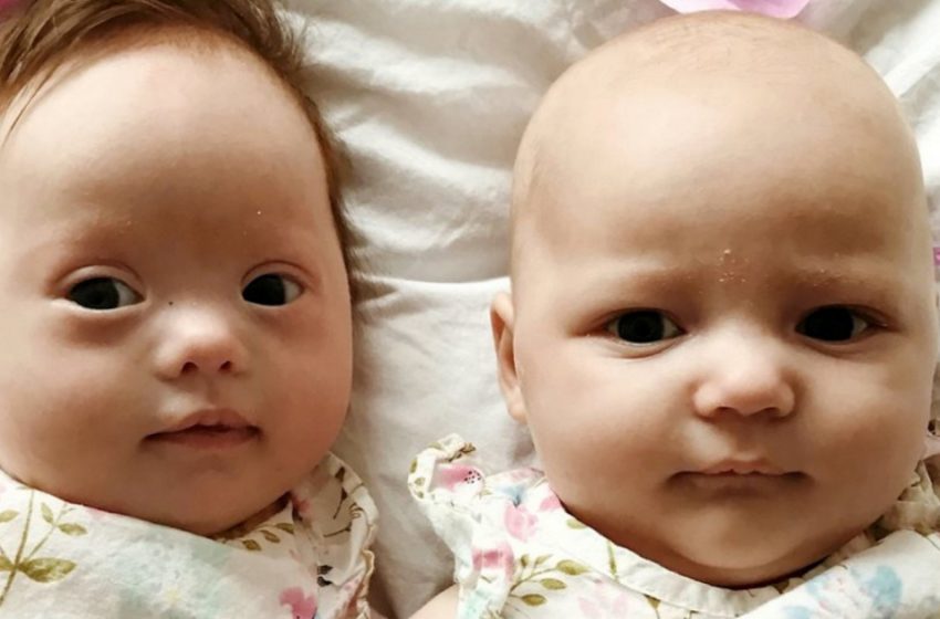 Twins with 1-in-a-Million Odds: One Has Down Syndrome, the Other Does Not!