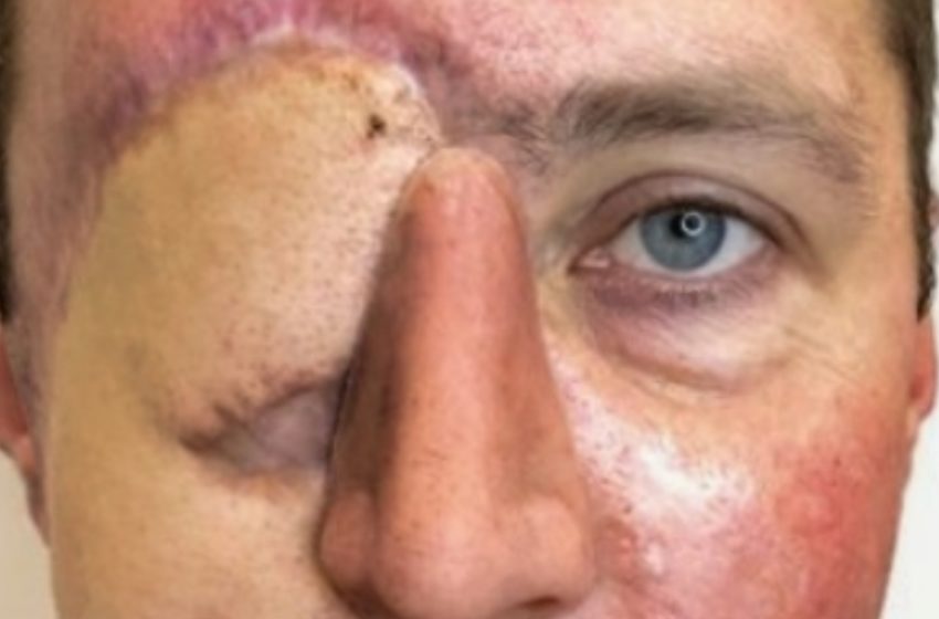 After Losing an Eye in a Car Accident, This Man Let a Tattoo Artist Redesign His Face!: The Results Are Beyond Incredible!