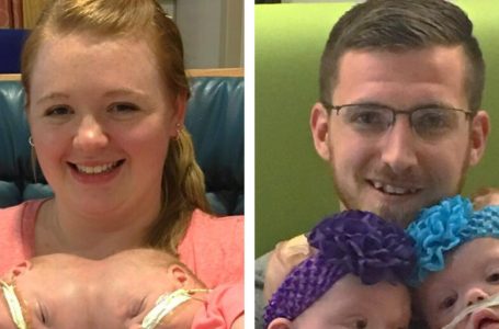 Conjoined Twins Celebrate Life 2 Years After Surgery!: What Do They Look Like Now?