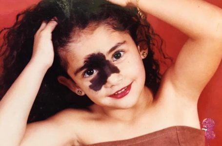 Bullied for Her Birthmark, Now She’s a Model Breaking All the Rules: What Does She Look Like Now?
