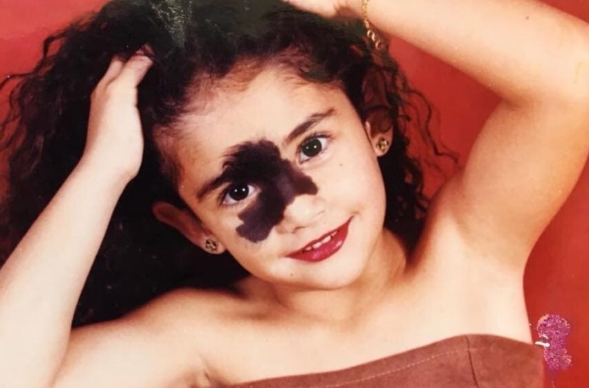 Bullied for Her Birthmark, Now She’s a Model Breaking All the Rules: What Does She Look Like Now?