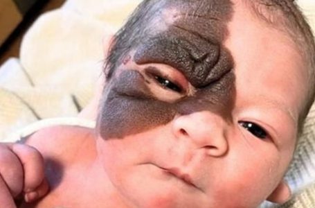 Born With a Unique Mark, This Brave Girl’s Amazing Transformation Will Melt Your Heart: Her Pics!