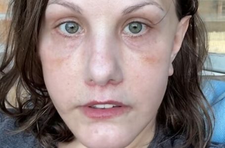 “Unrecognizable After $15K Facelift”: The Girl’s Transformation Has the Internet In Chaos!