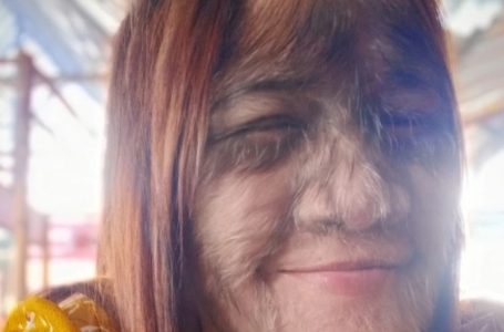 ‘World’s Hairiest Girl’ Fully Grown and Madly in Love!: See Her Astonishing Transformation!
