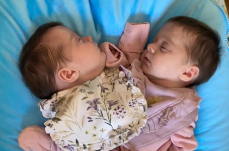 From Conjoined at the Chest to Thriving Kids: Separated Twins 3 Years Later—See Their Photos
