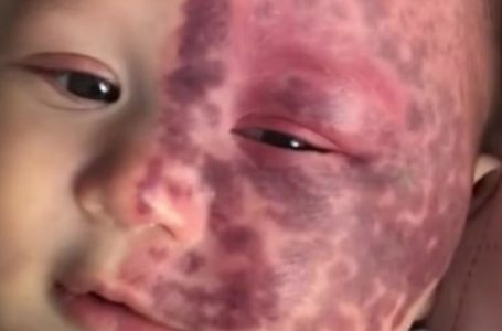 Mother Criticized for Controversial Laser Treatment Shows Son’s Stunning Transformation Three Years Later