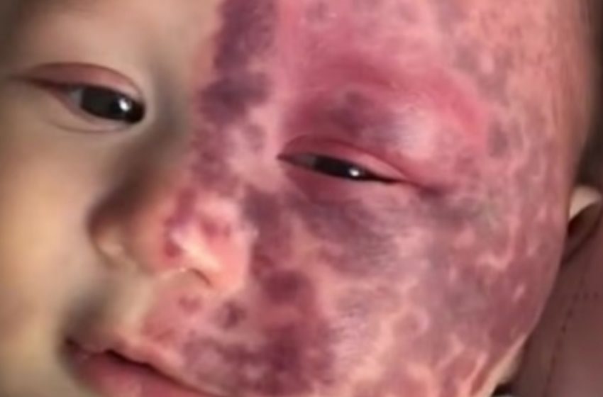 Mother Criticized for Controversial Laser Treatment Shows Son’s Stunning Transformation Three Years Later