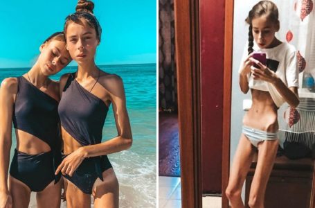 They Weighed Just 83 lbs and Nearly Died But They Overcome!: What Do They Look Like Now?