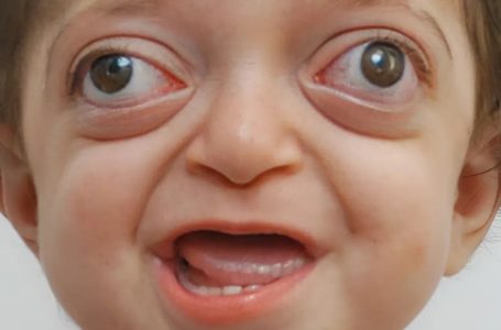 Doctors Transform Boy’s Unusual Face!: See His Remarkable Look After All the Changes!