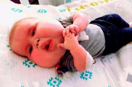 How This Little Boy, Born with an Unusually Large Face, Looks Today!: See The Photos!