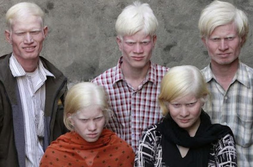 The World’s Largest Albino Family Captivates Attention!: See More Photos!