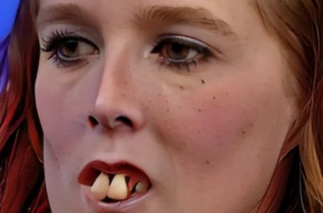 Famous for Her Unique Look: You Won’t Believe How She Looks Now After Dental Surgery!